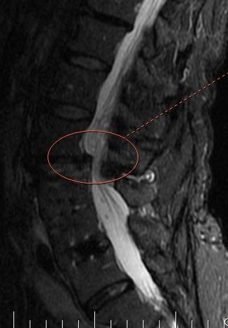 mri sag central stenosis marked