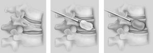 Kyphoplasty image